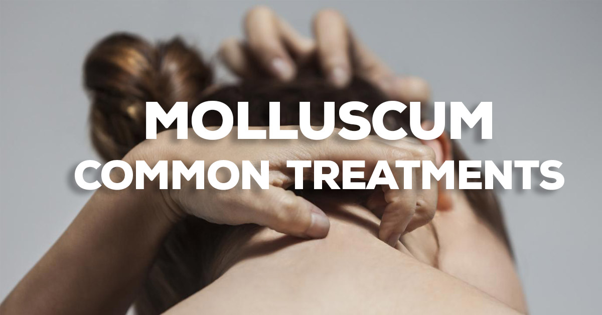 Common Treatments for Molluscum Contagiosum - Conzerol